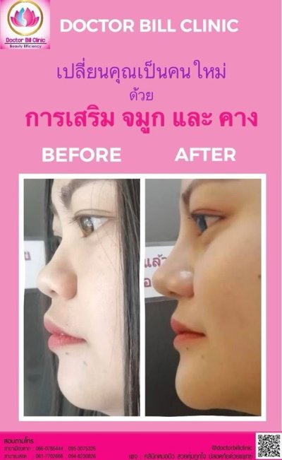 รูปผลการทำศัลยกรรมจมูก